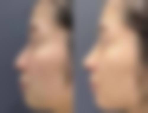 隆胸后喂奶对宝宝健康值不值