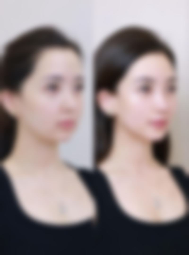 打除皱针能让我轻松告别皱纹重焕年轻光彩吗