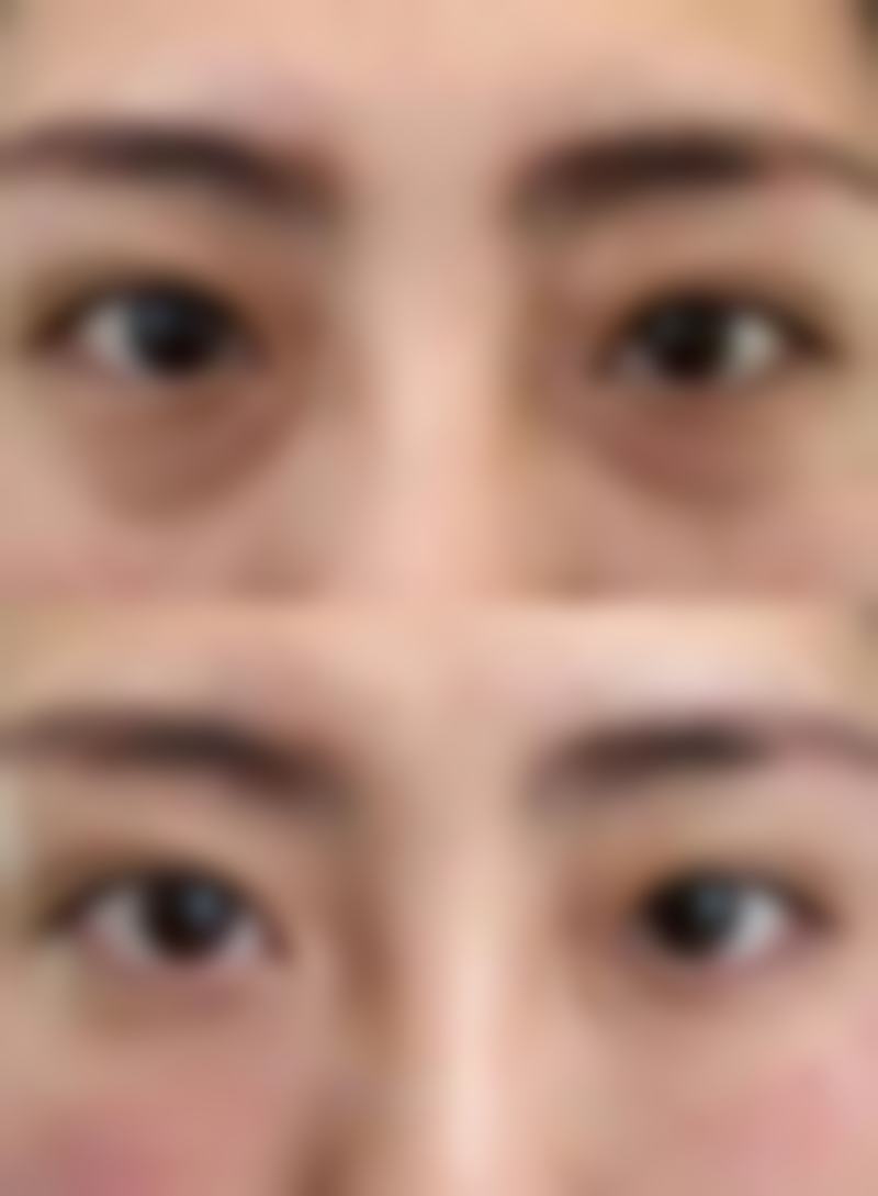 手术修复烫伤凹凸疤痕值不值？