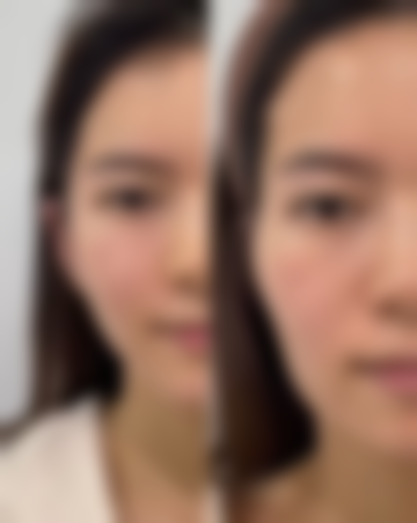 纳米无痕双眼皮术后如何护理