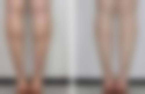 三点式定位双眼皮成效能维持多久