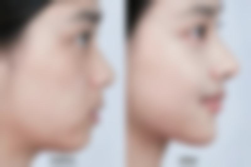 手术治疗疤痕疙瘩怎么样