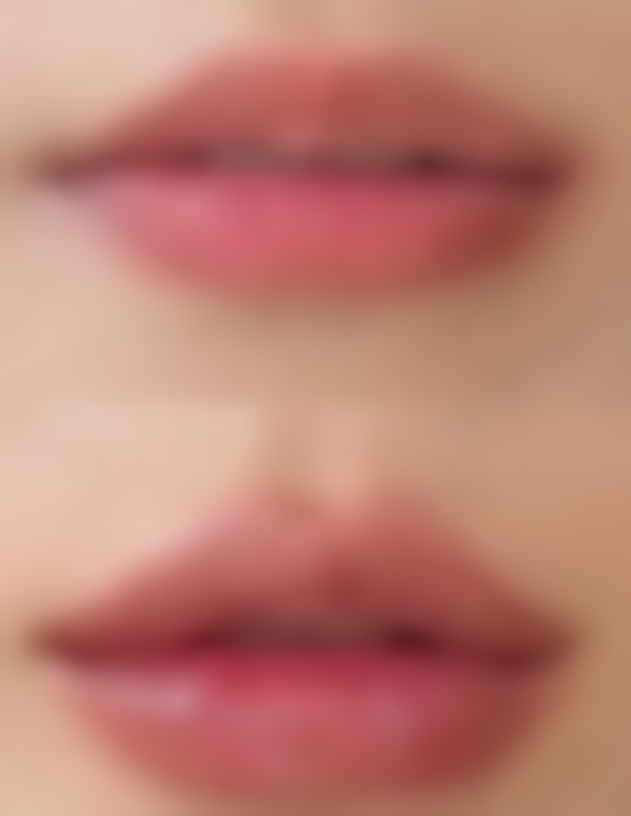 吸脂后做射频紧肤值不值