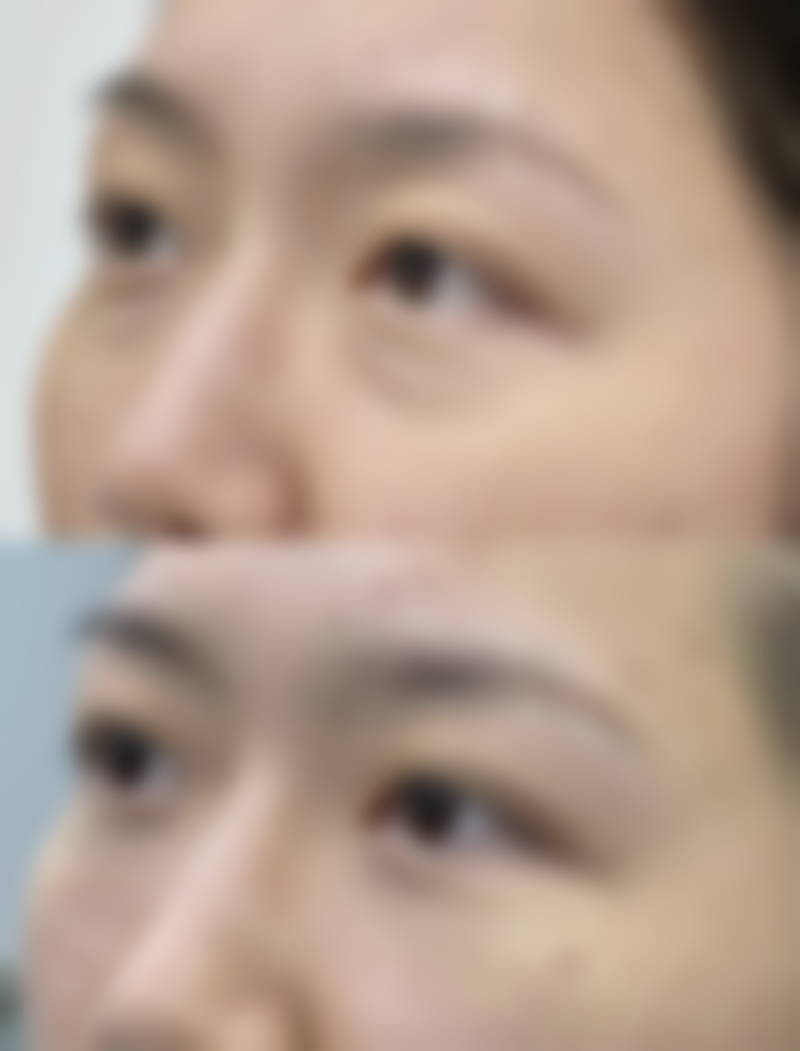 三点式定位双眼皮和切开法结合能实现恒久成效吗