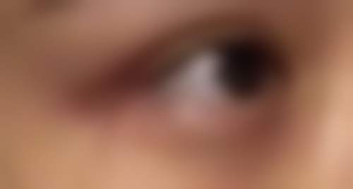 日常护理对去除眼袋有帮助吗