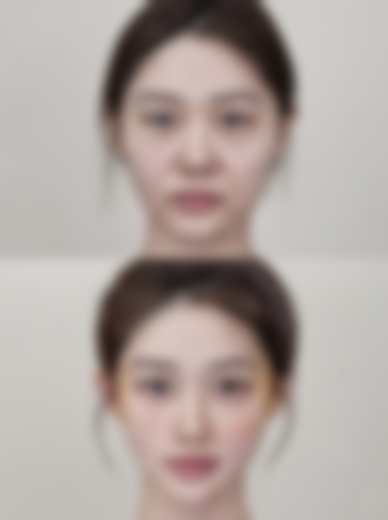 术后护理对降低疤痕增生复发几率靠谱吗