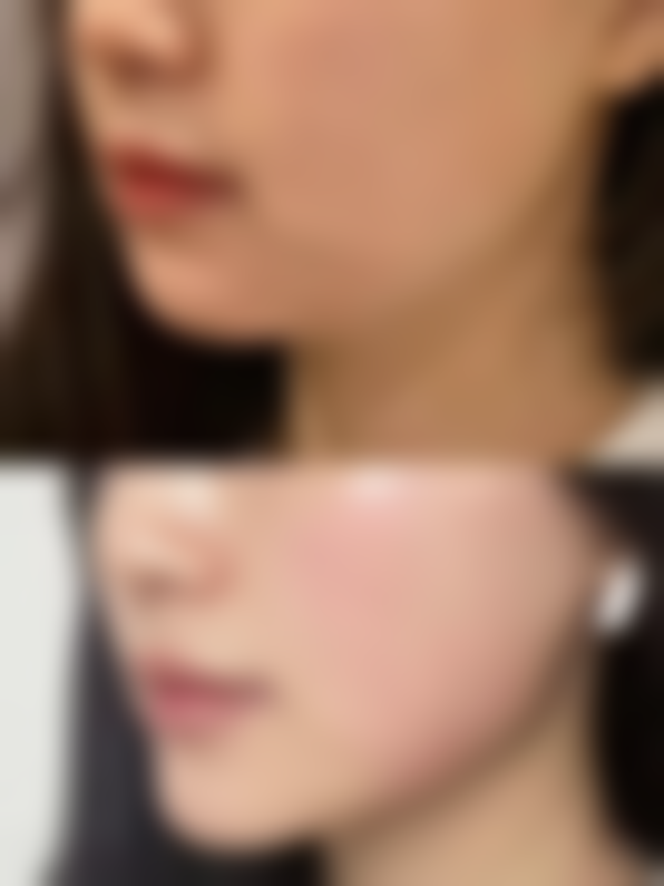 二次隆鼻提升美感适合所有人吗