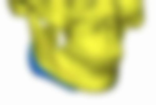 自体脂肪填充隆鼻靠谱吗