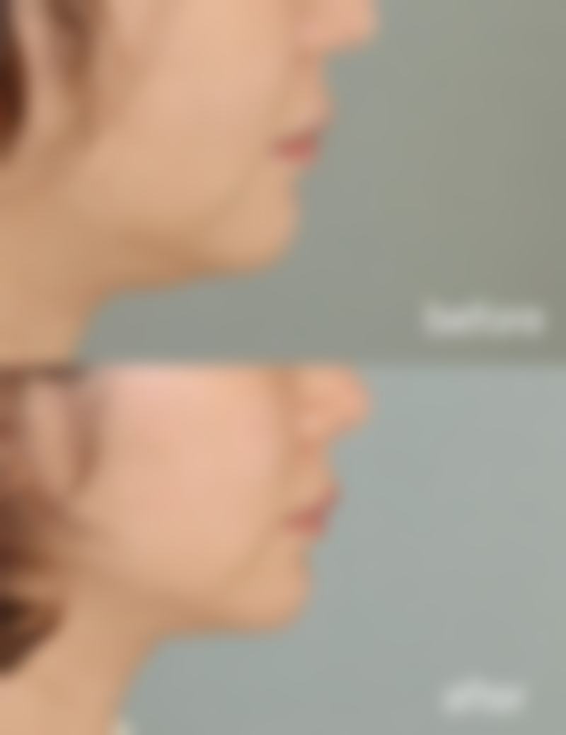 玻尿酸注射隆鼻怎么样