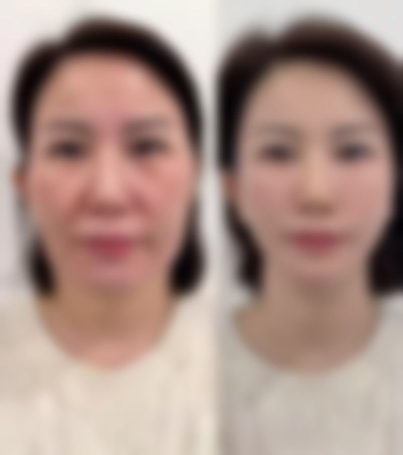 微晶磨皮适合消除疤痕体质胸前疙瘩吗