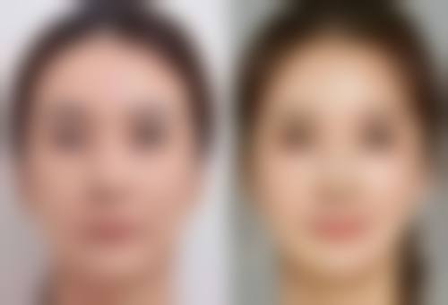 医美微晶磨皮去除鼻子凹陷疤痕靠谱吗