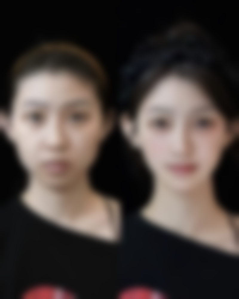 去除烫伤疤痕后会复发吗