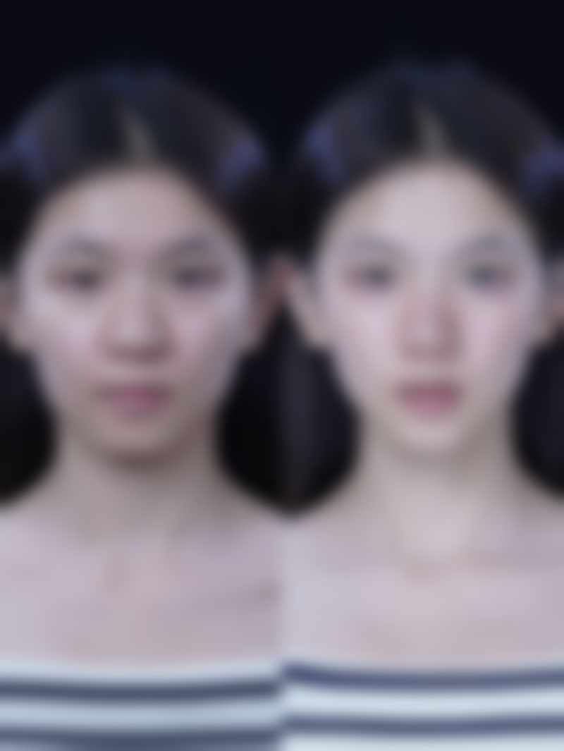 微晶磨皮去除烫伤疤痕适合吗