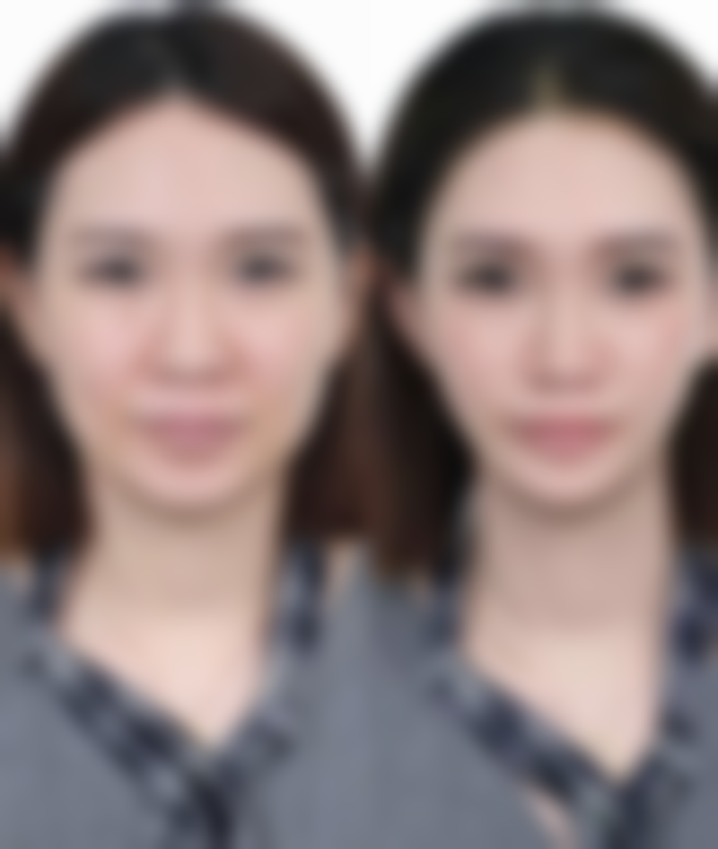 日常护理对去除鼻子凹陷疤痕有帮助吗