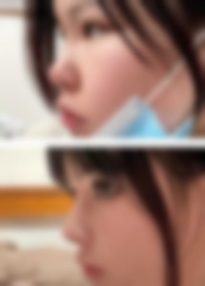 华美面部吸脂修复后成效怎么样