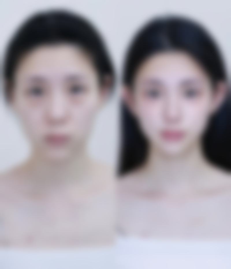 肋骨隆鼻定型成效怎么样判断