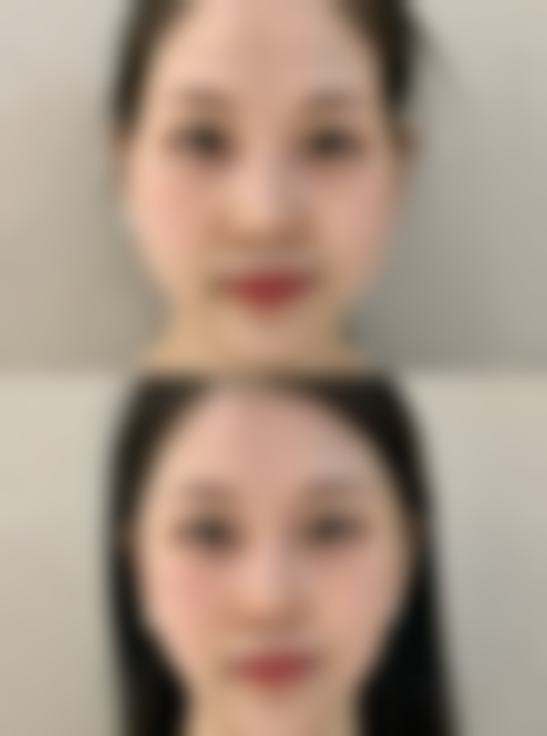 疤痕增生破皮后怎么护理能加速愈合