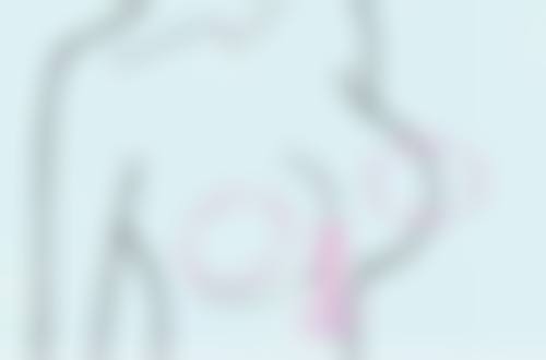 隆鼻鼻头有点歪抗感染治疗必要吗