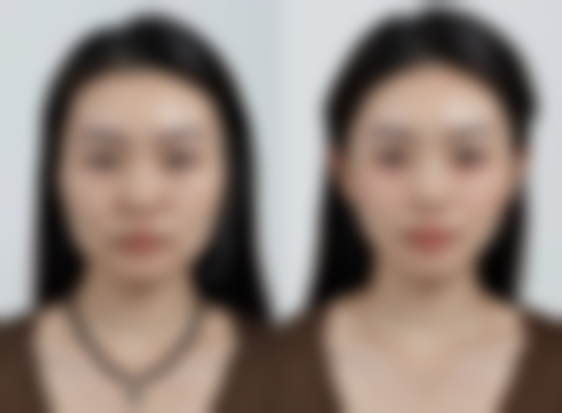 新生儿单眼皮变双眼皮有什么征兆？