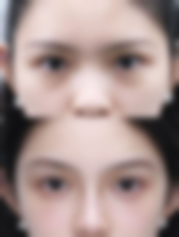 全脸打除皱针值不值