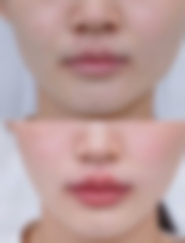 多磺酸粘多糖乳膏适合皮肤擦伤疤痕修复吗