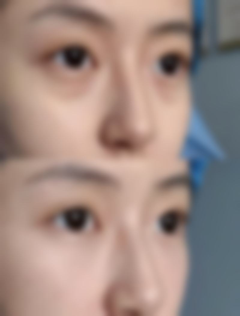 如何缩短隆胸修复期