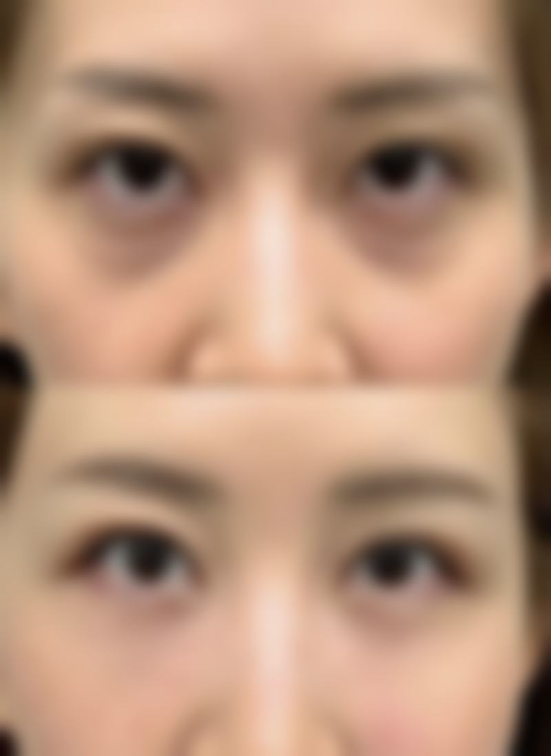 超声法去眼袋一次能搞定吗