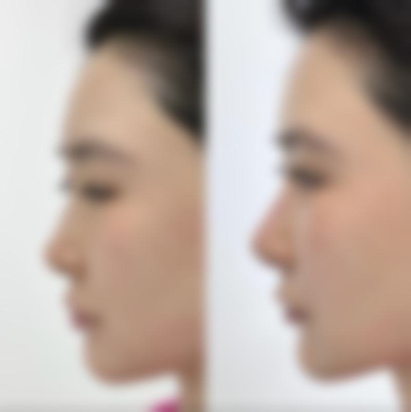 鼻子小隆鼻适合所有人吗