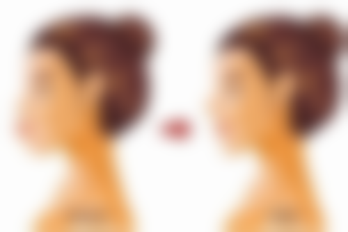 刚做完双眼皮为什么显老