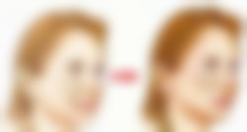 割双眼皮会显老吗