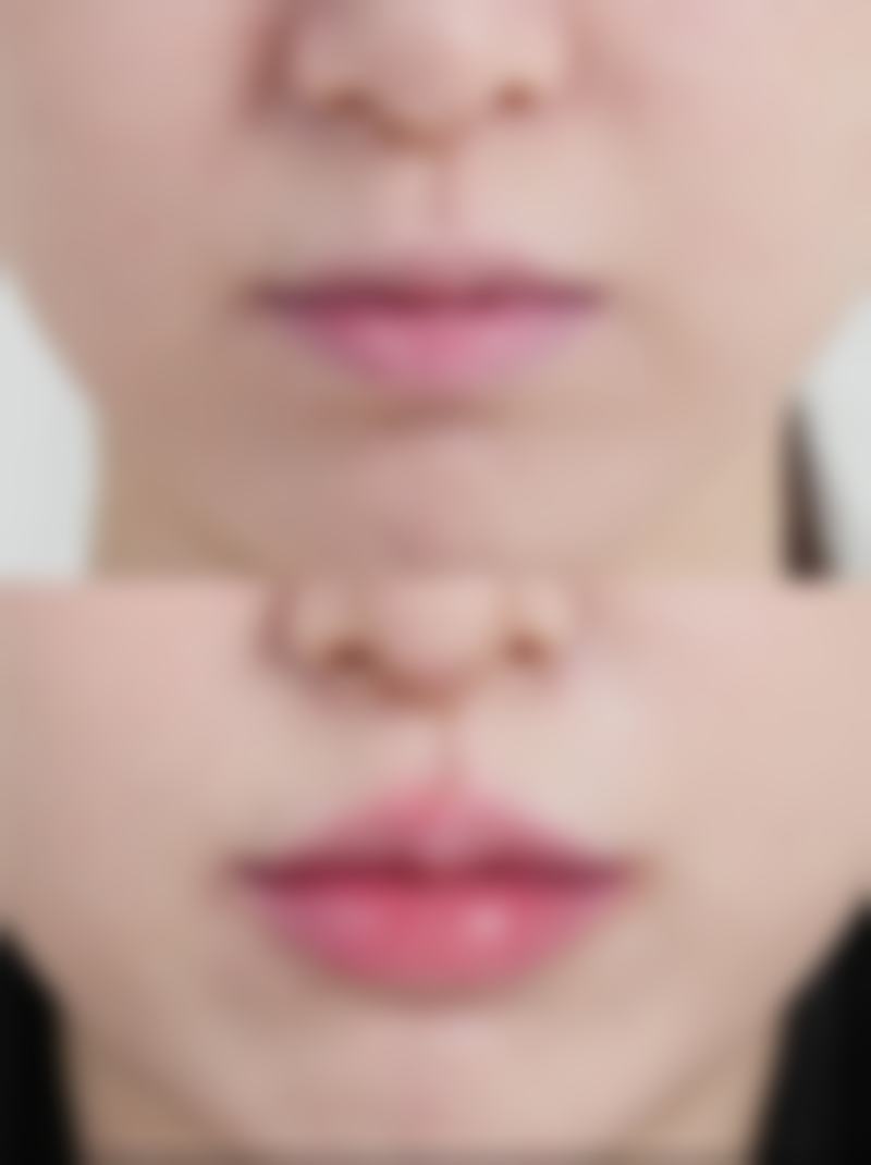 埋线双眼皮做了显老怎么办