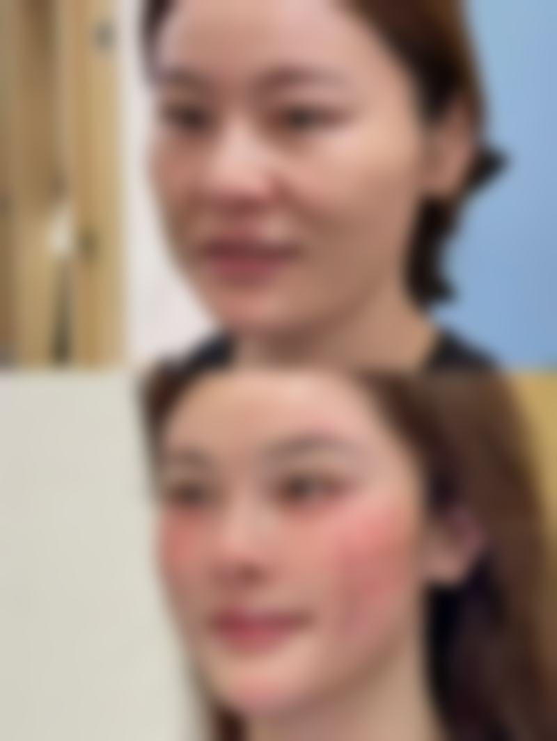 全切双眼皮会显老吗