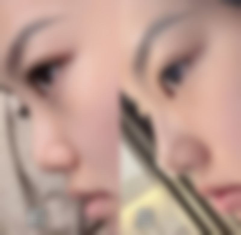 南通星范整形医院真实实例：见证美丽蜕变