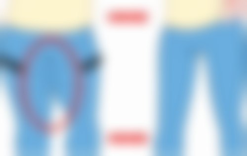 哪些因素会影响抽脂后疼痛消失的时间