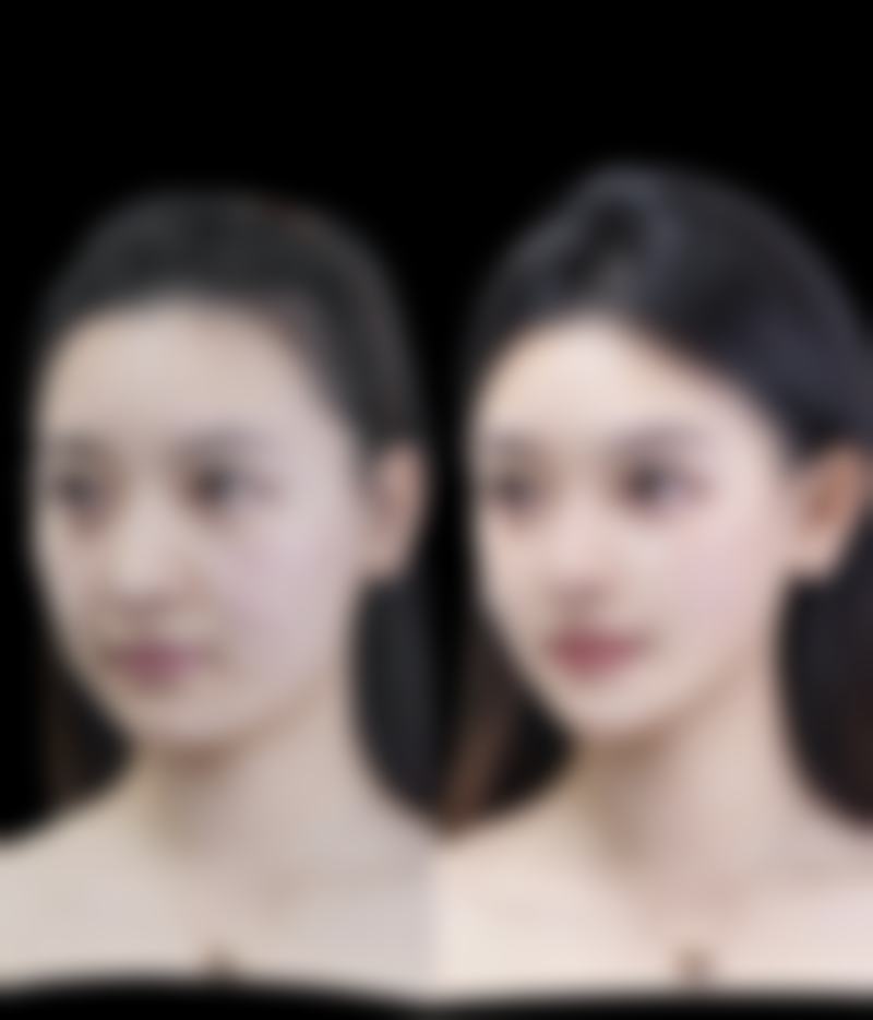 医美激光祛疤去除烫伤发紫疤痕靠谱吗