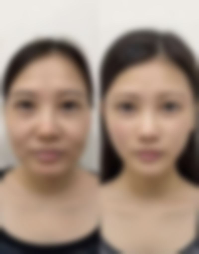 局部注射填充修复全切双眼皮太深适合吗