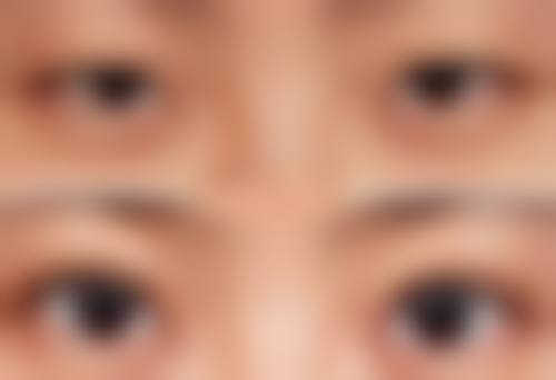 遗传因素对内双眼皮形成有多大影响