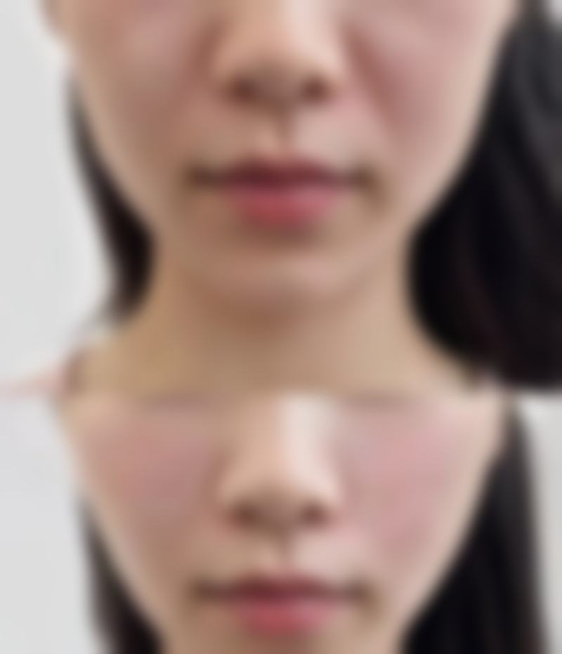 注射瘦脸针后成效能维持多久