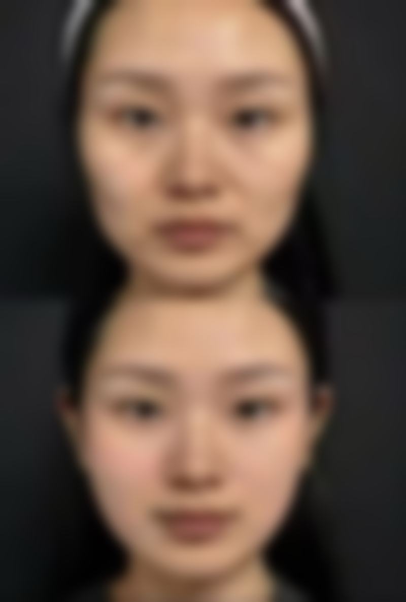 生活干预消除下眼袋肿胀值不值