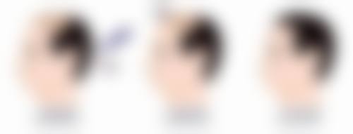肚子大抽脂后反弹了该怎么办?