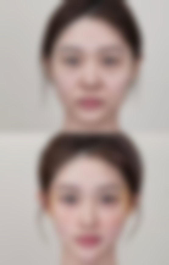 凹陷疤痕修复后能维持多久