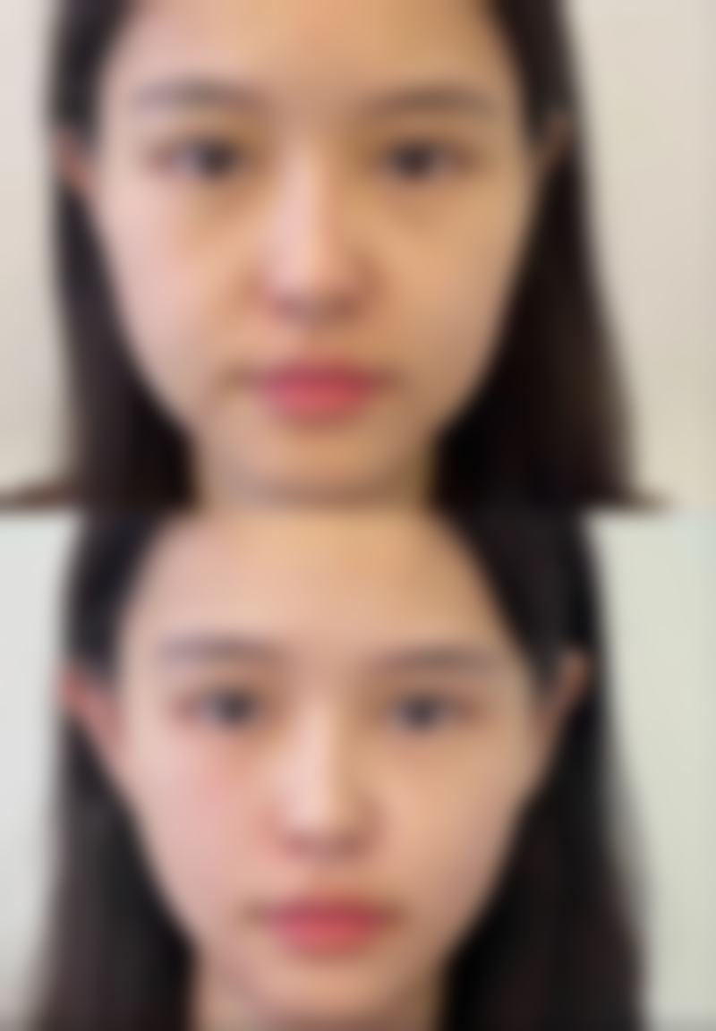 去除脸上痤疮疤痕后如何护理肌肤