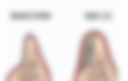 淡化双眼皮疤痕还有其他方法吗