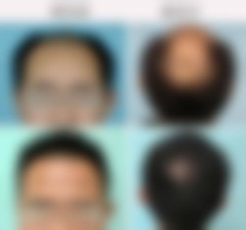 齐齐哈尔千百度整形医院真实实例