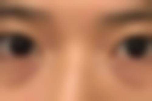 杜磊医生真实实例：见证美丽蜕变
