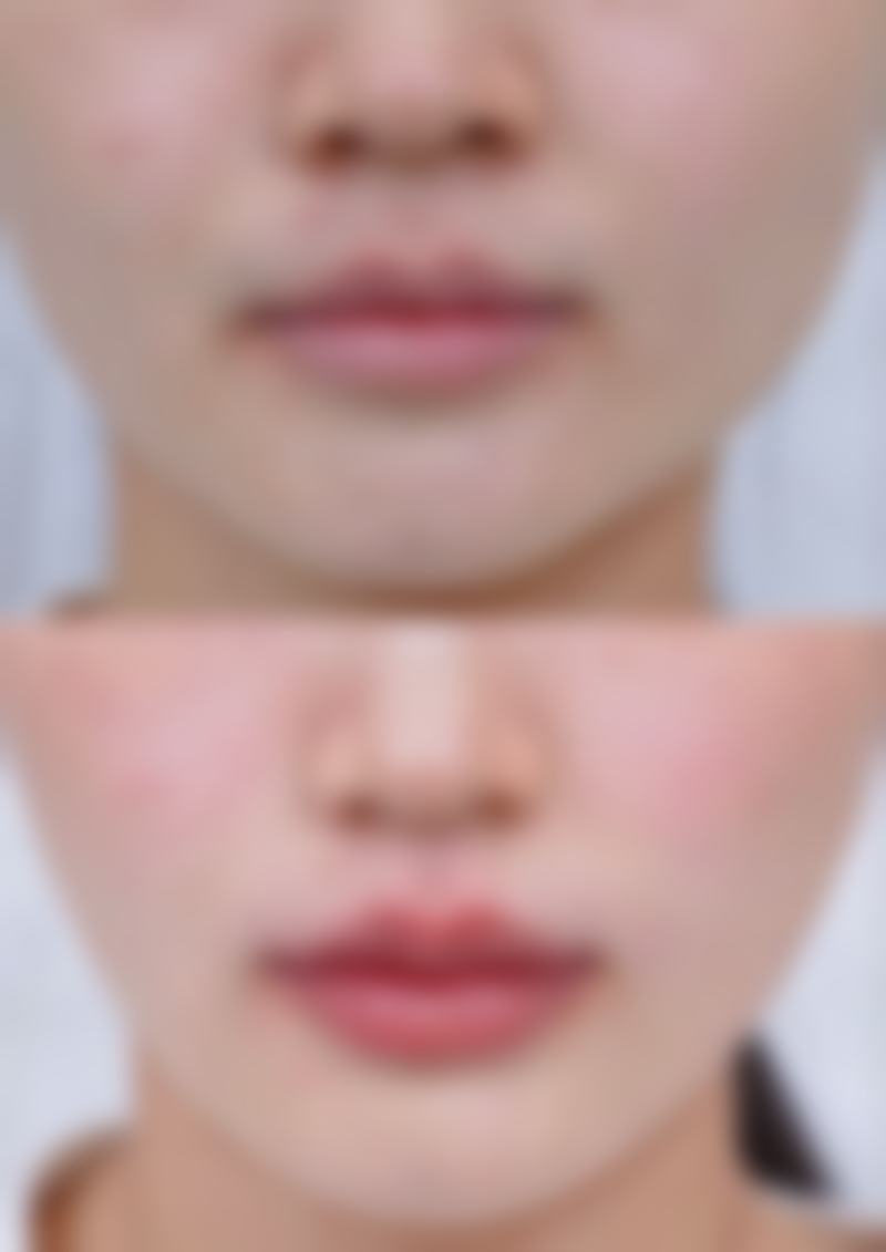 胸口长红色疤痕疙瘩采用医美激光治疗适合吗