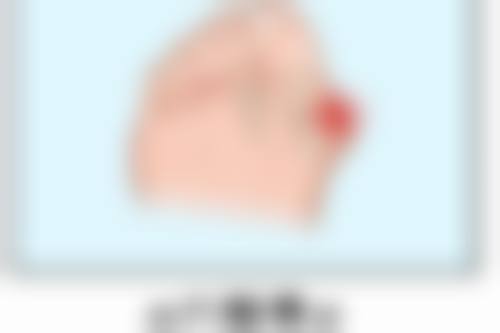 割双眼皮后如何加快修复自然的速度
