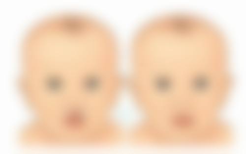 大腿腿部抽脂术前要注意什么