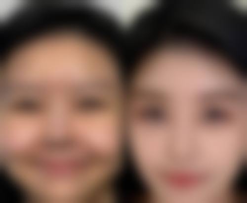 降低抽脂生命危险的有效方法有哪些