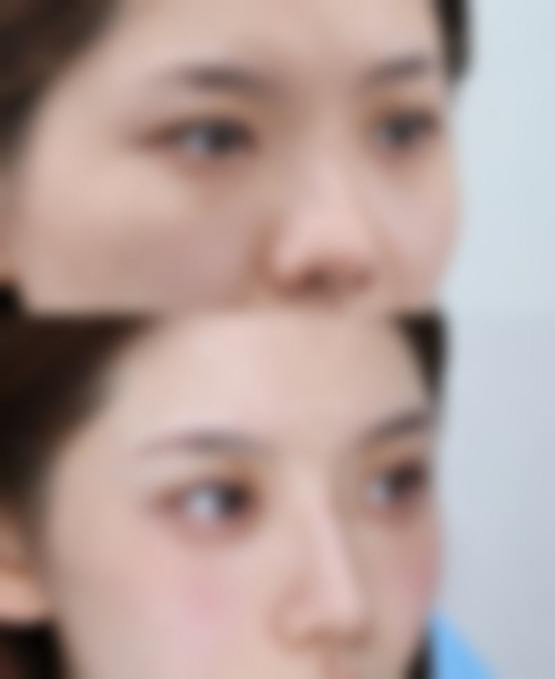 大腿腿部抽脂靠谱吗